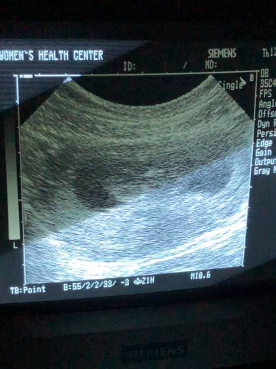What an Ultrasound Reveals